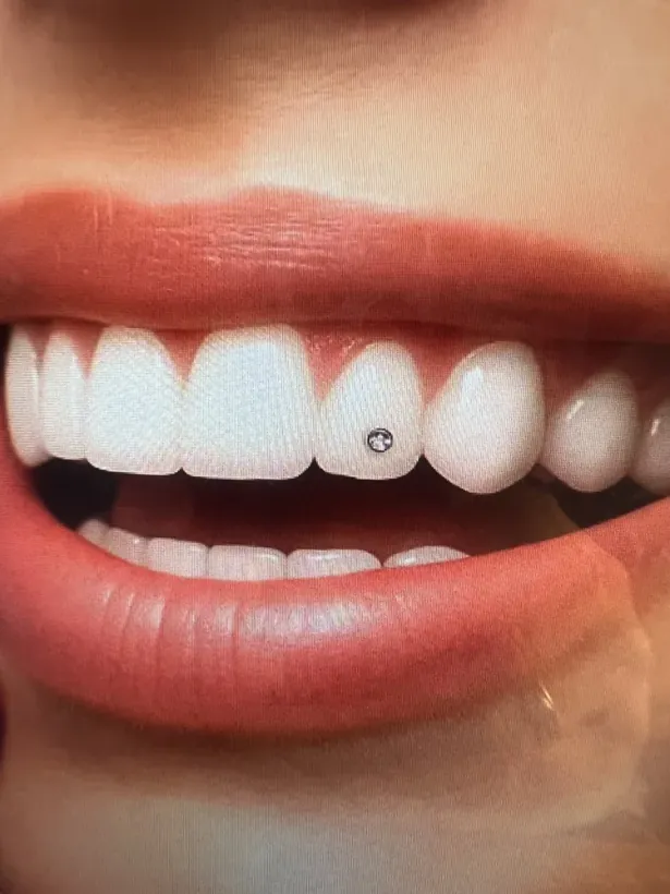 Dentálny šperk s kryštálom Swarovski nalepený na zube